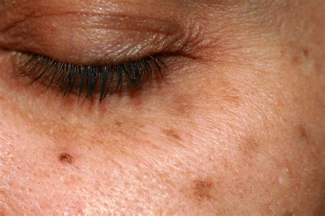 skin cancer vs age spots pictures